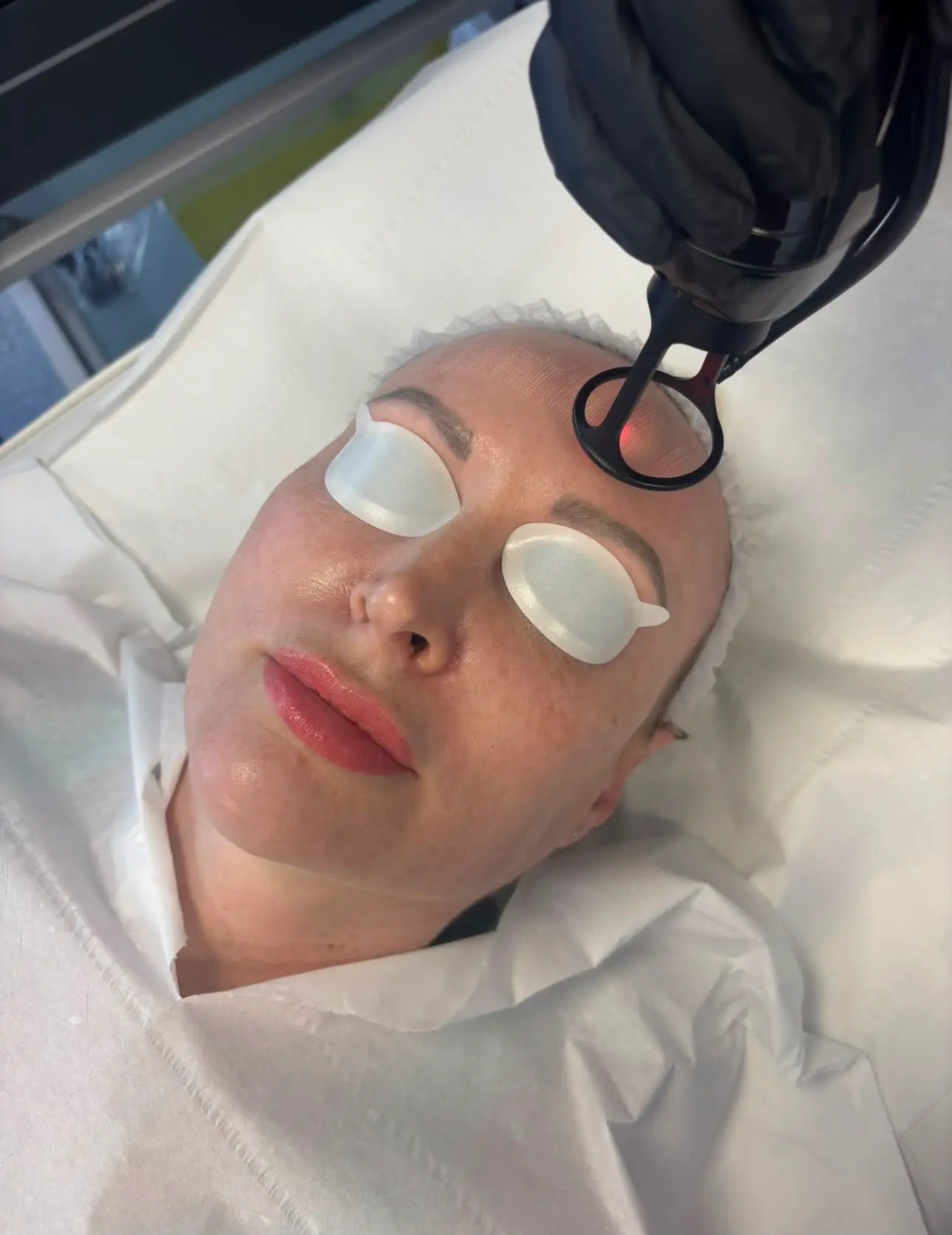 CO₂ Laser Skin Resurfacing treatment result at Sculpt Faces