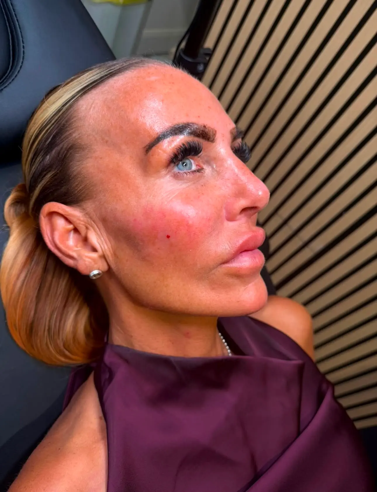 Facial Balancing treatment result at Sculpt Faces